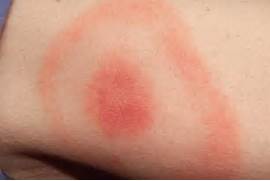 lyme disease treatment