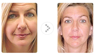 Microcurrent acupuncture facial rejuvenation images 40