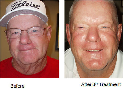 Microcurrent acupuncture facial rejuvenation images 827